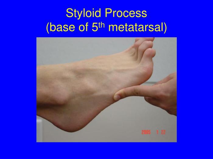 Styloid metatarsal process foot 5th base lateral anatomy surface presentation fifth ppt powerpoint