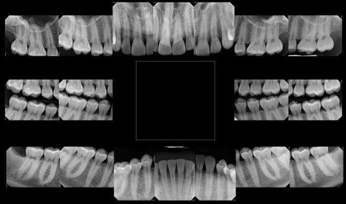 Scanning of traditional film-based radiographs into a digital image